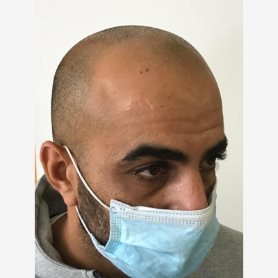 image_Hair Tatoo : Solution à la calvitie et perte de cheveux