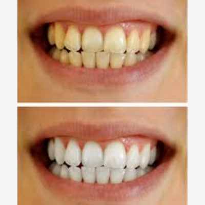 image_Microneedling/BB GLOW/BLANCHIMENT DENTAIRE/CARBON LASER PEEL/SOIN CHEVEUX BOTOX CAPILLAIRE/INJECTION HYALURON PEN