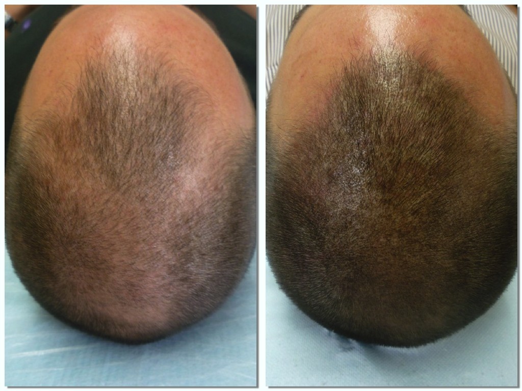 image_ALOPECIE CALVITIE PELADE BAHIA DERM CABINET DE DERMOGRAPHIE